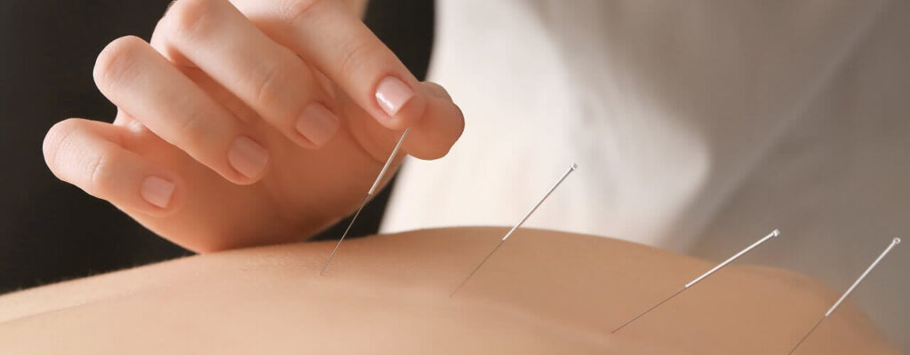 The Benefits of Acupuncture