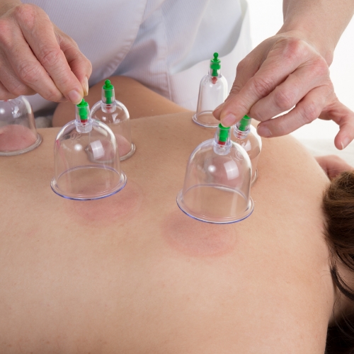 Cupping-Bloor-Jane-Physiotherapy-and-active-rehabilitation-Toronto-ON