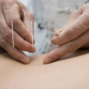 Dry-needling-Bloor-Jane-Physiotherapy-and-active-rehabilitation-Toronto-ON
