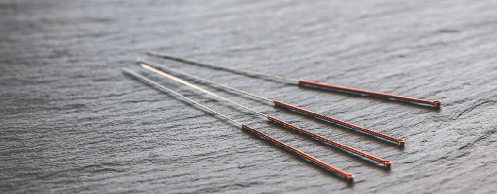 Acupuncture for Chronic Pain: Everything You Need to Know