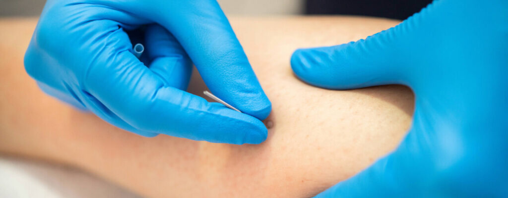 Acupuncture for Muscle Pain Relief